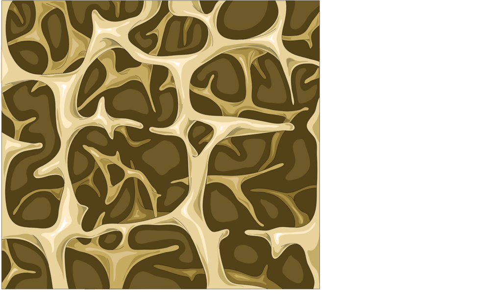 Illustration of spongy bone changing from normal to thinned to osteoporotic.