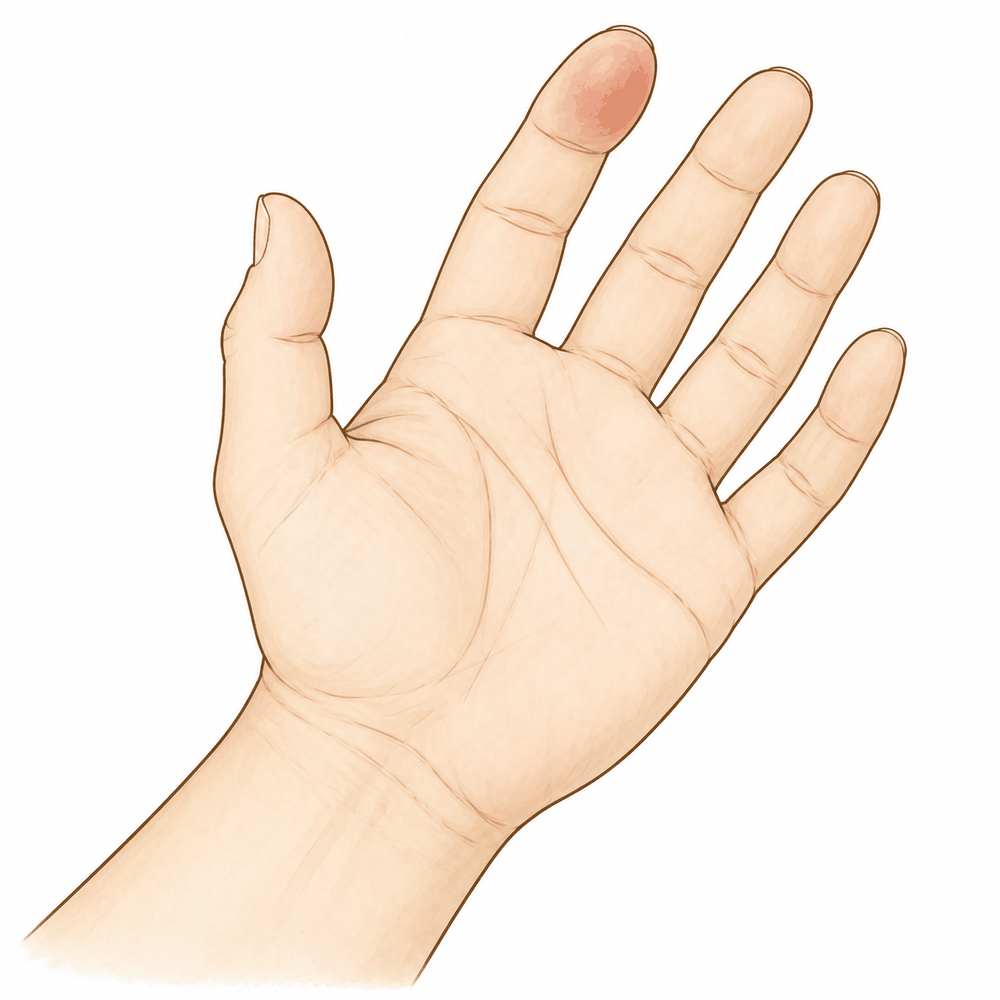 Illustration: Felon (Fingertip Pulp Infection)