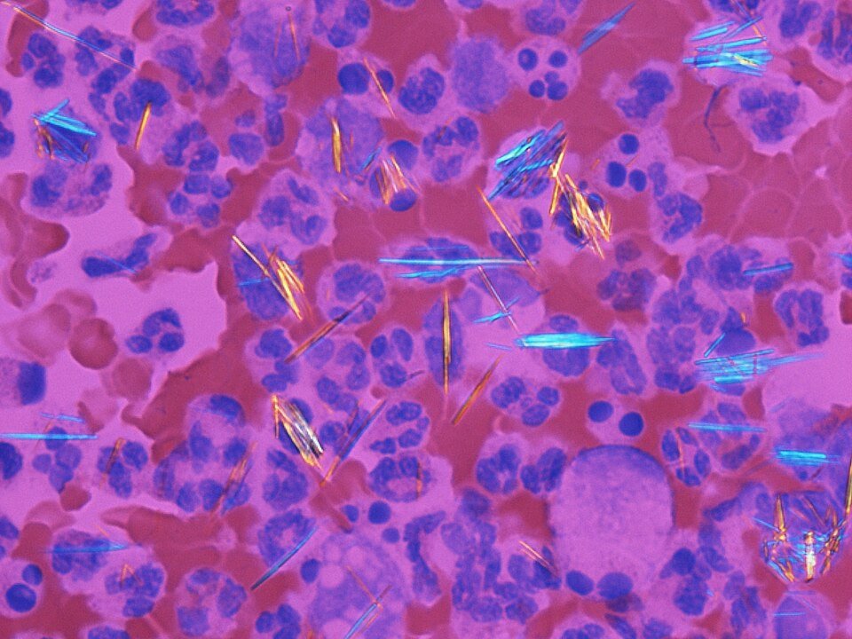 Polarised-light microscopy of joint fluid showing needle-shaped monosodium urate crystals among immune cells.