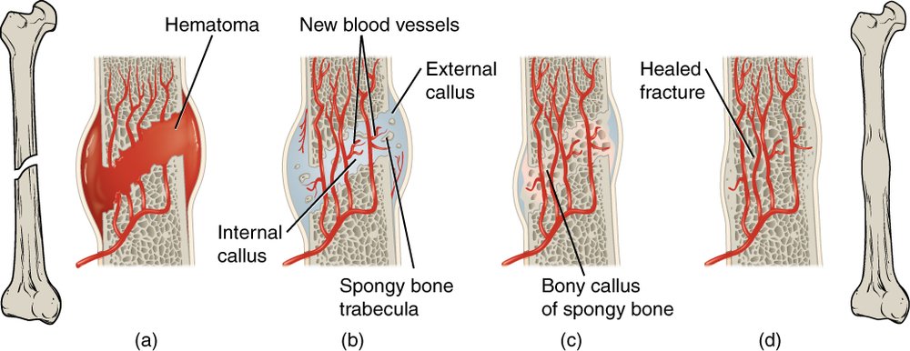 Four stages of fracture repair — fracture haematoma, fibrocartilaginous (soft) callus, bony (hard) callus, and remodelling.