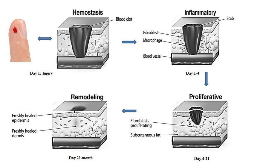 Four-panel diagram of wound healing — haemostasis (clot, day 1), inflammatory (day 1-4), proliferative (day 4-21), and remodeling (day 21 to months).