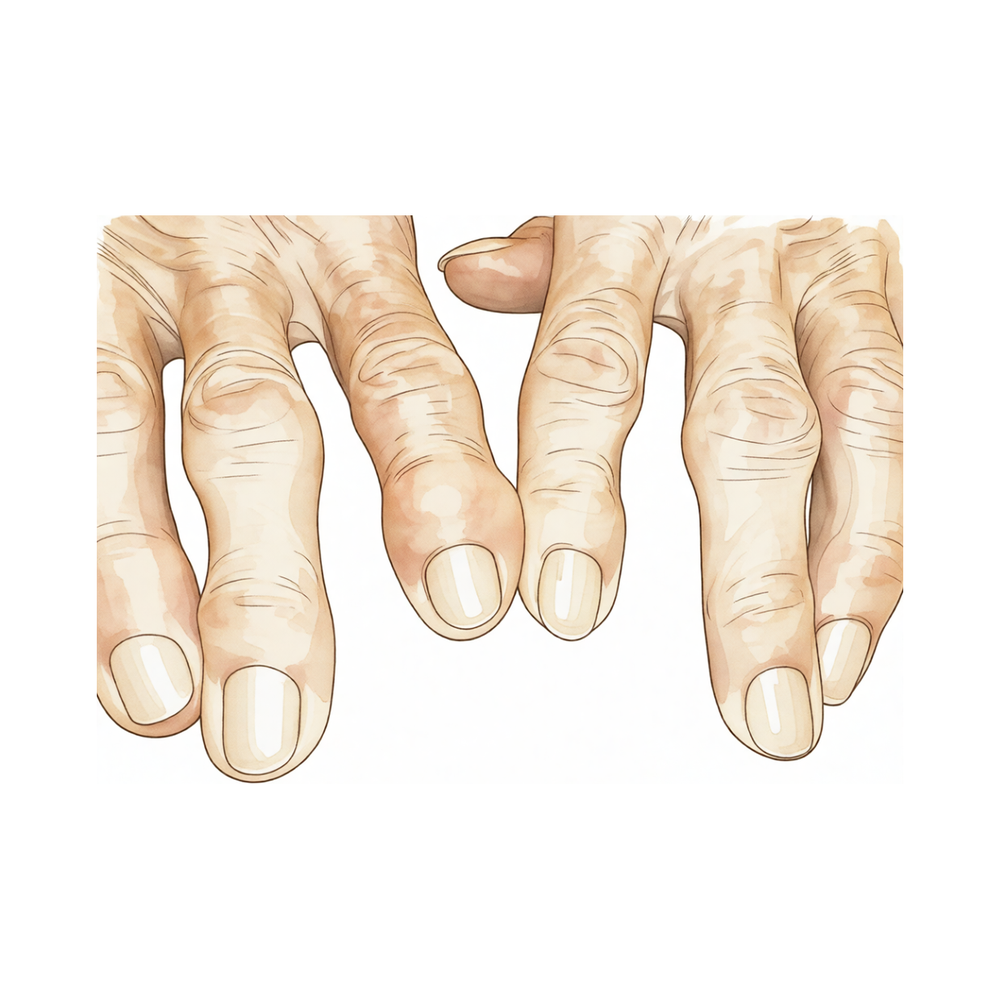 A hand with the knobbly, swollen finger joints of osteoarthritis.