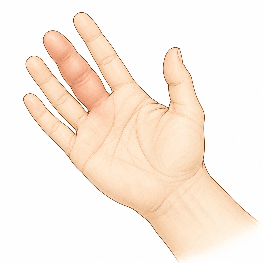 Illustration: Infected Flexor Sheath (Pyogenic Flexor Tenosynovitis)