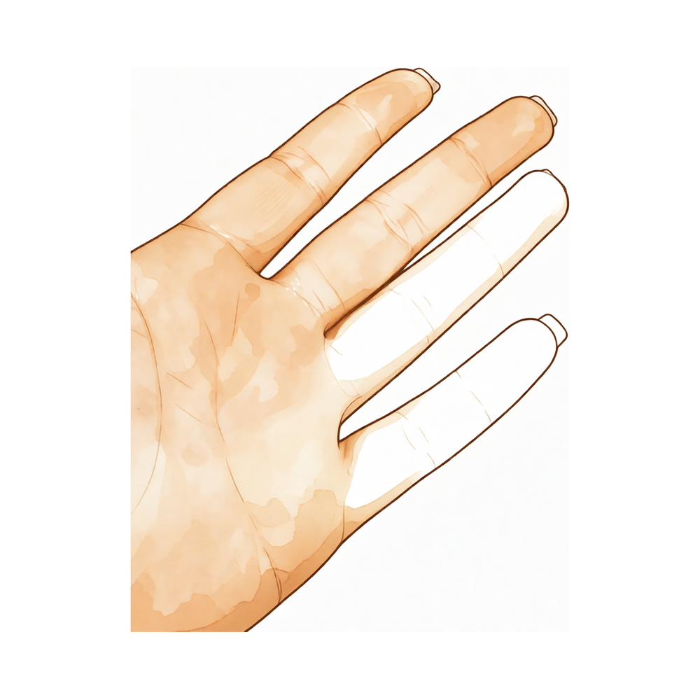A hand with some fingers blanched pale during a Raynaud's attack.