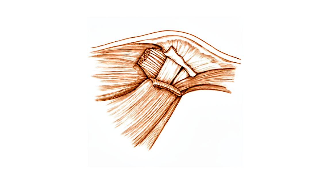 Diagram of a torn ulnar collateral ligament at the main knuckle of the thumb.