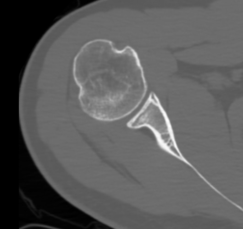 A CT cross-sectional slice through the shoulder.