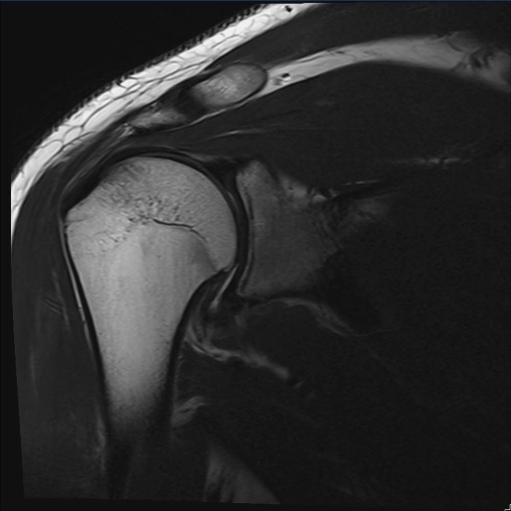 A greyscale MRI slice through the shoulder.