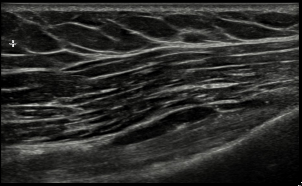 A greyscale ultrasound image of a shoulder tendon — the grainy, fibrillar view.
