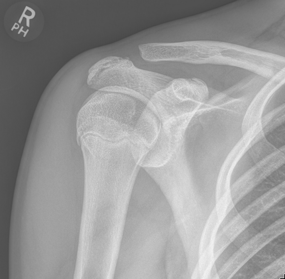 An X-ray of the shoulder — bones bright white against a dark field.